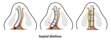 sua-mui-veo-vach-ngan-1