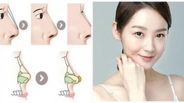 NÂNG MŨI BẰNG SỤN TỰ THÂN HOÀN TOÀN CẦN LƯU Ý